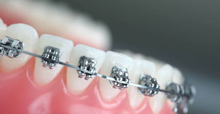 Braces and Orthodontics at Bambi Dental Clinics