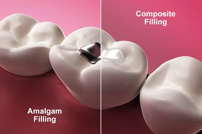 Tooth Fillings at Bambi Dental Clinics