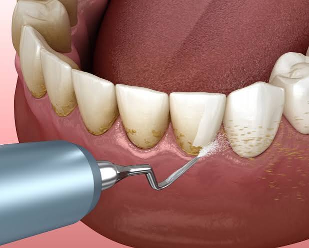 Scaling and Polishing / Teeth Cleaning at Bambi Dental Clinics
