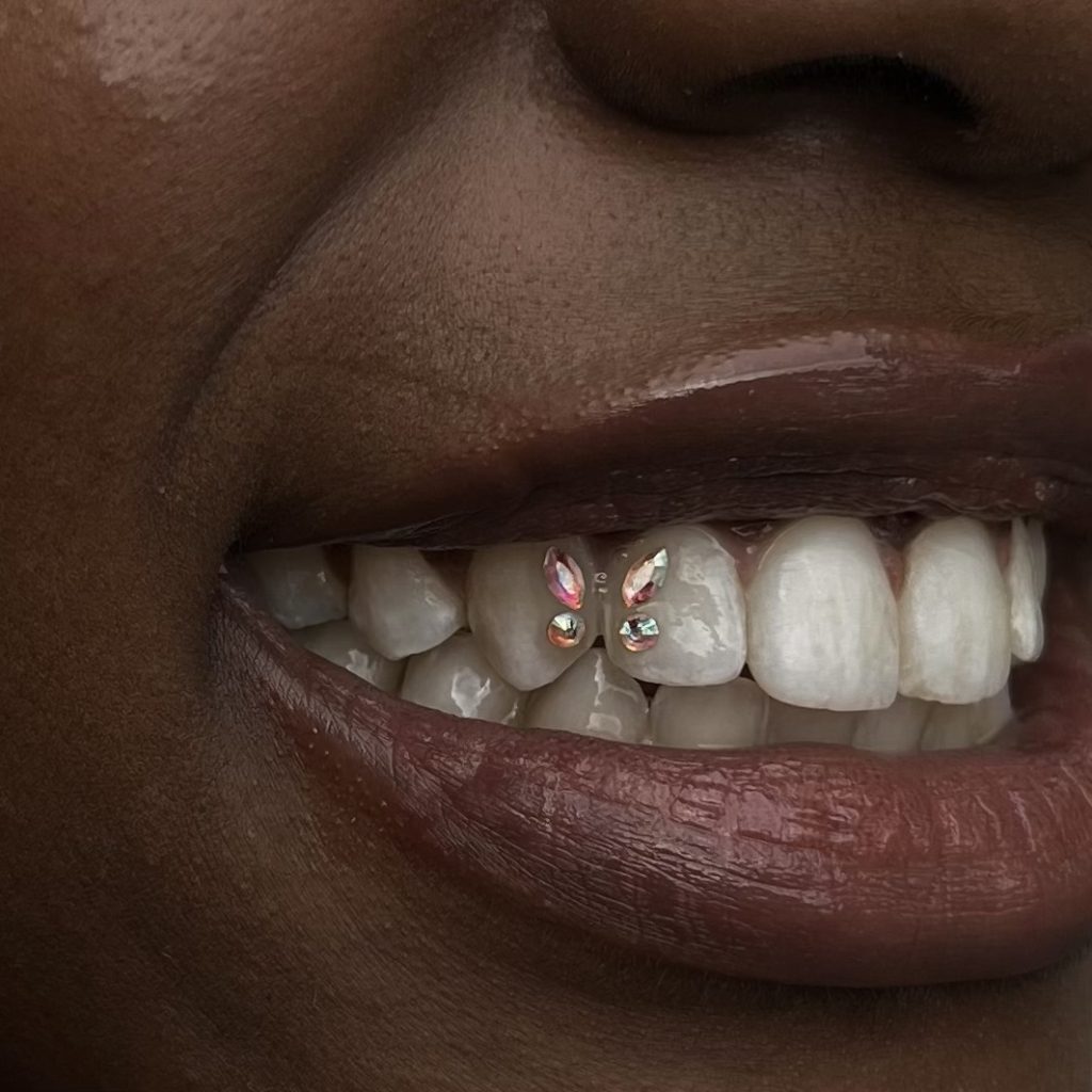 Tooth Gems Application at Bambi Dental Clinics